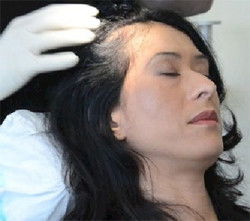Hair Transplant Abroad - Hairdresser Find 1