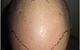 Hair Transplant Abroad - thumb 5