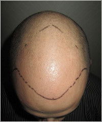 Hair Transplant Abroad - Hairdresser Find 5